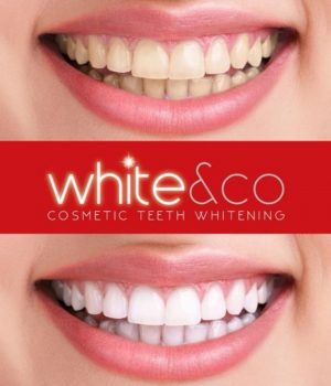 teeth whitening peterborough